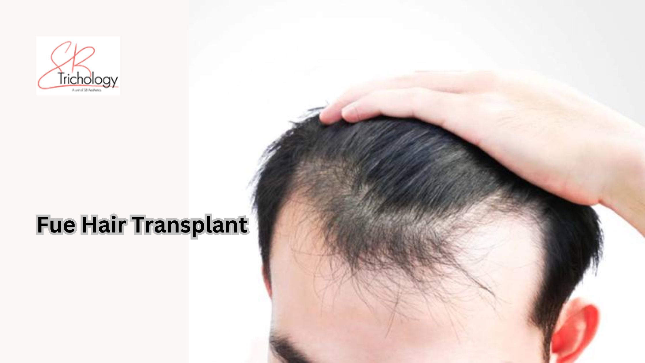 Fue Hair Transplant In Gurgaon